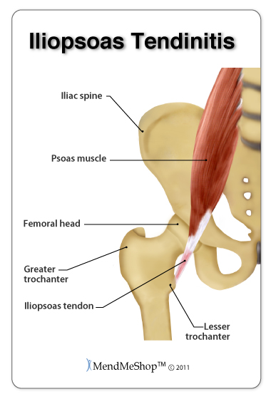 Hip Tendonitis pain